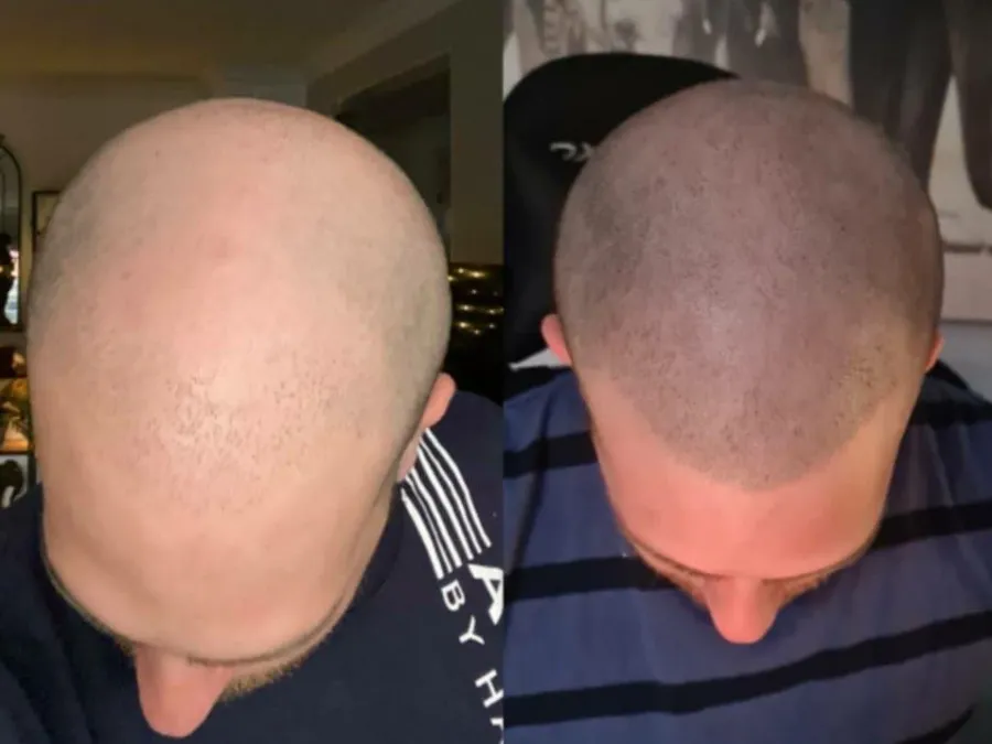 scalp tattoo melbourne — in practice