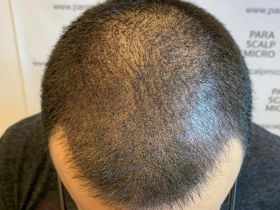 Scalp tattoo melbourne guides